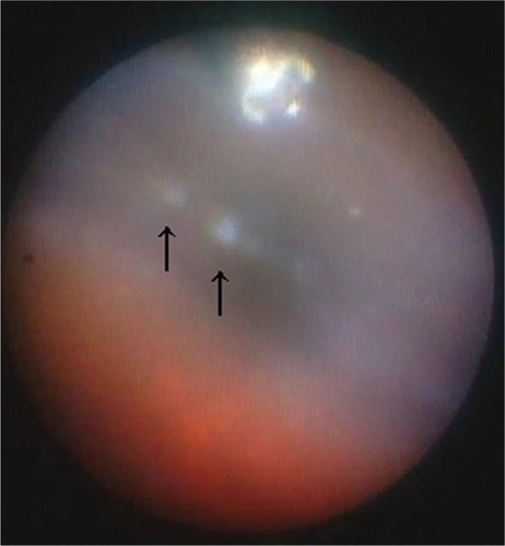 Figure 1 Intraoperative endoscopic findings with a 23-gauge cannula inserted into the eye through the pars plana. Vitreous gel entrapping triamcinolone acetonide particles (arrows) can be observed around the intraocular edge of the cannula.