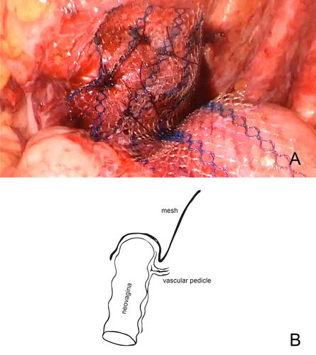 Figure 3 (A) During the second surgery a single mesh strip was placed over the apex of the neovagina. It was not possible to dissect the anterior compartment down to level of the bladder neck and at the posterior wall the vascular pedicle had to be spared. (B) The sketch illustrates schematically the course of the mesh and the relation of the vascular pedicle.