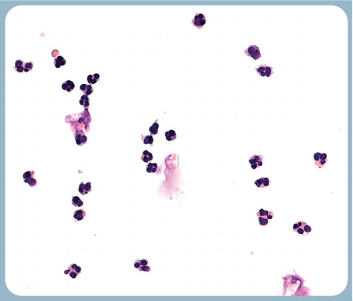 Figure 2. Clinical histological evidence of inflammation due to the inability of macrophages to digest triamcinolone acetonide crystals.Seen in an aqueous humor aspirate of a patient with noninfectious endophthalmitis after intravitreal triamcinolone acetonide, showing neutrophil infiltration and a fibrinous reaction, suggesting presence of phagocytic cells in the vitreous.Reprinted with permission from Chi Chao Chan, MD (National Eye Institute, MD, USA).