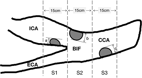 Figure 1 The measurement of the carotid plaque score.