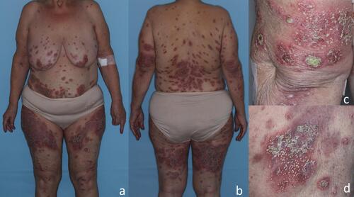 Figure 1 Clinical presentation of the patient on admission. Scattered pustules over diffuse, symmetrical erythematous patches and plaques that arise predominantly on the lower back and upper thighs (A and B). The lesions coalesced into crusted erythematous plaques covered with larger pustules and lakes of pus over extensor surface of the left elbow (C) and inner upper left thigh (D).