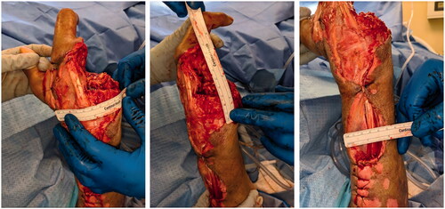 Figure 3. After serial debridements.