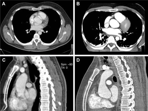 Figure 4 (A) and (C) showing non-ECG-gated axial and coronal CTA images suggesting dissection at the level of the aortic root in patient 5. (B) and (D) showing the ECG-gated CT scan of the same patient subsequently performed on a 256-MSCT device that showed no aortic dissection.