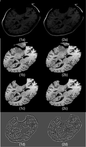 Figure 18. Two-dimensional experimental results for modeling of the third resection in Case 3. (1a) The fourth iMR image. (2a) The fifth iMR image. (1b) The image resulting from brain shift, first resection, and second resection modelings, identical to Figure 16(2b). (2b) Deformation of (1b) using the surface displacement field of the biomechanical model, computed via FEM (using XFEM is also possible). (We say “surface” since we are working in two dimensions.) (1c) The image resulting from brain shift, first resection, and second resection modelings, identical to Figure 16(2c). (2c) Deformation of (1b) with resection, performed by masking (2b) with the brain region segmented from the fifth iMR image (2a). (1d) Juxtaposition of Canny edges of (1c) and the brain part of (2a). (2d) Juxtaposition of Canny edges of (2c) and the brain part of (2a).