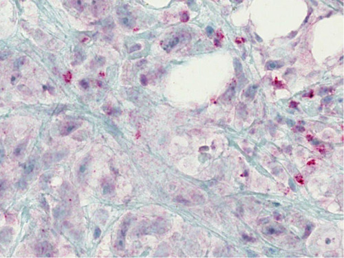 Figure 10 Breast cancer and associated connective adipose tissue. There are also distinct R/C-stained cells, while the breast cancer epithelial tracts show only mild-to-moderate, non-specific background staining.