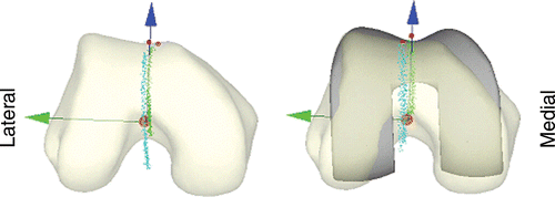 Figure 4. A sample distoproximal visualization of a pre-arthroplasty femur (left), derived from bone-morphed geometry, is shown beside the corresponding post-arthroplasty femur overlaid with the femoral component position (right). The righthand (green) line shows the trajectory of the centre of the patellar median ridge, while the lefthand (blue) line shows the trajectory of the distal end of the median ridge throughout several cycles of flexion. The custom visualization software also allowed the patellar path to be viewed dynamically. [Color version available online.]