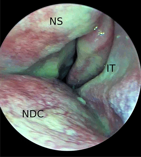 Figure 2 Preoperative nasal endoscopy shows a cystic lesion on the hard palate.