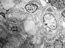 Figure 2. Electron microscopic examination shows normal glomerular capillaries. Electron dense deposits, light chain, or amyloid are not seen (original magnification × 2000).
