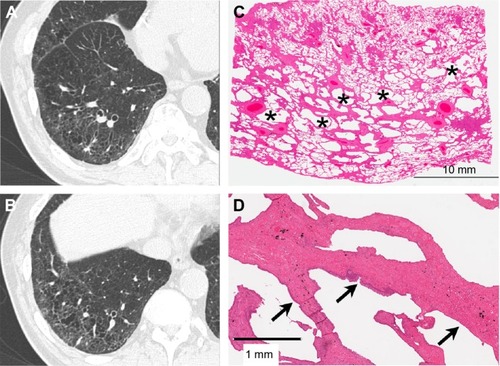Figure 4 Mild SRIF with emphysema pattern on thin-section CT images and histological findings.Notes: (A and B) Thin-section CT images showing clustered cysts with visible walls in the peripheral zone with less involvement of the subpleural parenchyma. The size and shape of the cysts vary. Note ground-glass attenuation with reticular or branching structures in the surrounding area. (C) This low-power photograph of the histological section (hematoxylin–eosin stain) reveals irregularly shaped emphysematous spaces (asterisk) with thickened fibrotic walls corresponding to clustered cysts with visible walls on the thin-section CT image. There is patchy fibrosis at peribronchiolar and subpleural sites corresponding to ground-glass attenuation with reticular or branching structures in the surrounding area. Irregular cysts with thickened walls are present apart from the pleura with less-involved subpleural lung parenchyma. (D) On this high-power photograph of a histological section, fibrosis of this pattern consists of hyalinized paucicellular fibrosis (arrow) or SRIF.Abbreviations: SRIF, smoking-related interstitial fibrosis; CT, computed tomography.
