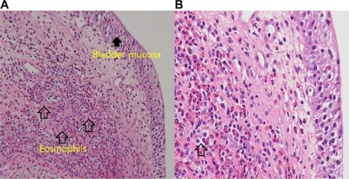 Figure 2 Histopathologic examination of the specimen obtained by cystoscopy showed infiltration of the bladder submucosa by numerous eosinophils.