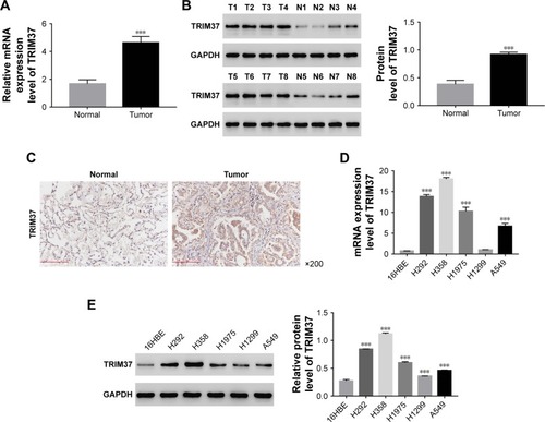 Figure 1 Expression of TRIM37 in lung cancer tissues and cell lines.