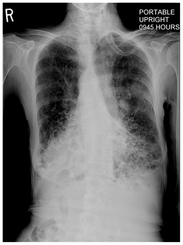 Figure 1 Bronchiectatic areas at the bases with air–fluid levels and new consolidation in left mid and upper lung zones. Dextrocardia and right-sided stomach air confirm a case of situs inversus.