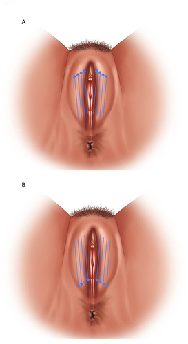Figure 1 Scheme of tread implantation from (A) Perineal entry point and from (B) Pubic entry point.