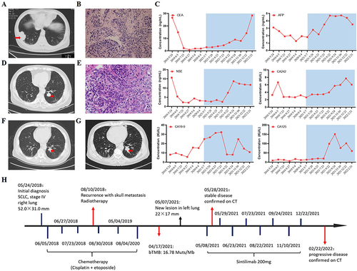 Figure 1 The treatment history of this patient. (A) Computed tomography (CT) from initial diagnosis on May 24, 2018 (Right lung: 52×31 mm). The red arrow indicates the tumors. (B) Hematoxylin-eosin staining of right lung (400 X). (C) Laboratory examinations of serum tumor marker. (D) CT images of new lesion in left lung on May 7, 2021 (Left lung: 22.0×17.0 mm; Right lung: 9.0×6.0 mm). The red arrow indicates the tumors. (E) Rebiopsy samples after chemotherapy resistance showed transformation to LUSC (400 X). (F) CT images of post PD-1 inhibition treatment on December 22, 2021 (Left lung: 18.0×16.8 mm; Right lung: 5.9×5.1 mm) and (G) recent re-examination on February 21, 2022 (Left lung: 34.0×20.0 mm; Right lung: 6.8×5.6 mm). The red arrow indicates the tumors. (H) Timeline of the clinical course in this patient.