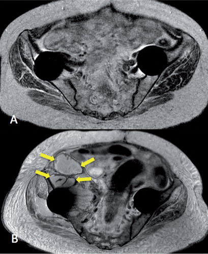 Figure 5. Example of new pseudotumor formation (arrows) in a patient with bilateral Birmingham hip resurfacing. T2-weighted MRI images. Date of implantation was January 2007, time from operation to first MRI (panel A) was 69 months, and time from operation to second MRI (panel B) was 84 months.