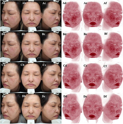 Figure 1 Clinical and erythema area images of the patient taken by the VISIA® Complexion Analysis System. (A) Before MF-HIFU treatment (Aa–Ac: Clinical manifestation images; Ad–Af: Red area images). (B) One month after the first treatment (Ba–Bc: Clinical manifestation images; Bd–Bf: Red area images). (C) One month after the second treatment (Ca–Cc: Clinical manifestation images; Cd–Cf: Red area images). (D) Six-month follow-up (Da–Dc: Clinical manifestation images; Dd–Df: Red area images).