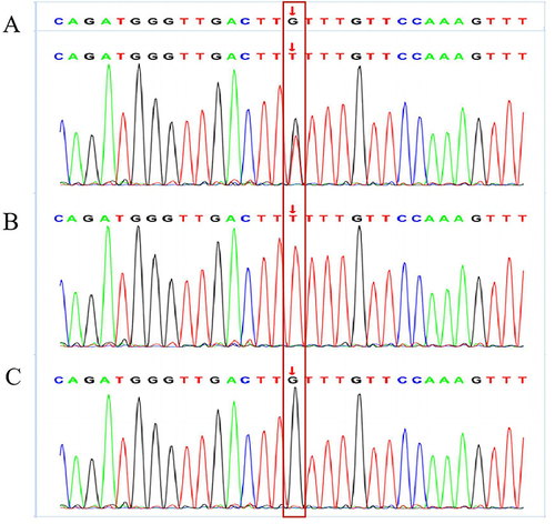 Figure 1 Characteristics of TBG mutants. (A): gene sequence of this patient; (B): gene sequence of the patient’s father; (C): gene sequence of the patient’s mother.