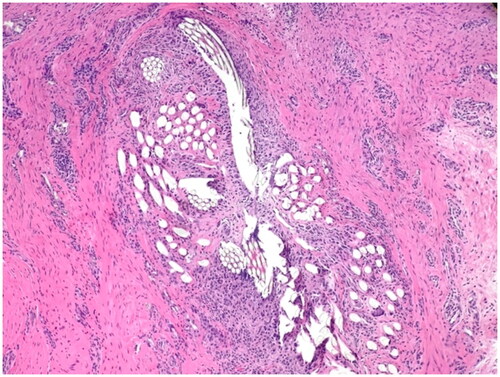 Figure 3. Pathological examination (patient 2) of the granulomatous material showed a pronounced inflammatory foreign body reaction. Bacterial cultures showed growth of Staphylococcus aureus, sensitive to isoxazolyl penicillin. Postoperatively, the patient was treated with oral flucloxacillin for one week.