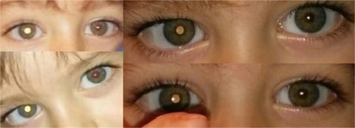 Figure 1 Four different smartphone photographs. In all pictures the child is not fixing directly on the camera, which resulted in a white pupillary reflex. Leukocoria is due to reflection off the optic nerve head.