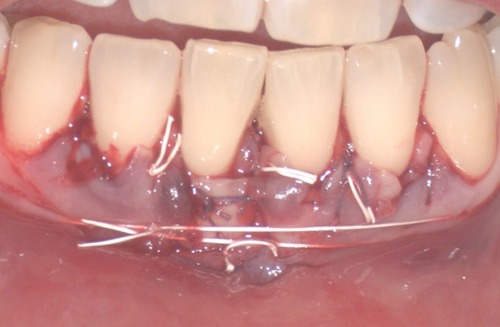 Figure 4 Epithelial-connective tissue graft.