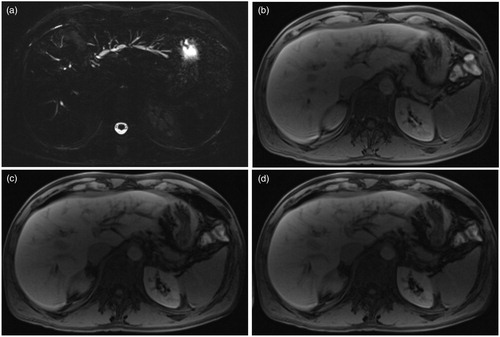 Figure 3. Gadoxetic acid-enhanced liver MRI of a 42-year-old patient with PSC. 3 D MRCP (a), T1-weighted images in transitional phase (3 min after contrast injection) without (b) and with application of MinIP with 12 mm (c) and 16 mm (d) thick slab.