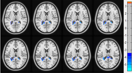 Figure 3 Regions of WM showing ALFF differences between PACG and HC groups.