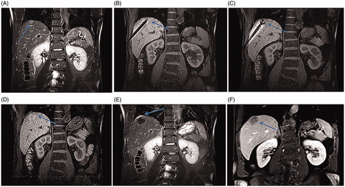 Figure 2. Recurrent HCC in the hepatic dome of a 59-year-old man treated with MR-guided RFA. (A) The recurrent nodule in segment VIII (arrow) is 15 mm in diameter and appears hyperintense in a coronal T2WI before RFA. (B–C) The RF electrode (arrow in B) is targeted gradually using the tilting of the puncture path under the coronal 3D-T1WI guidance. When the RF electrode reaches the edge of the nodule, the inner expandable multitined electrodes are expanded to 2.5 cm to overlap the nodule (arrow in C) without penetrating the diaphragm. (D–E) After RFA, the nodule is completely overlapped by the rim of hyperintensity on 3D-T1WI (arrow in D) and hypointensity on T2WI. Crescent-shaped effusions (arrow in E) are clearly displayed with the hyperintense signal in coronal T2WI between the liver capsule and the diaphragm. (F) The lesion (arrow) is completely ablated without a diaphragm injury at 3-month follow-up.