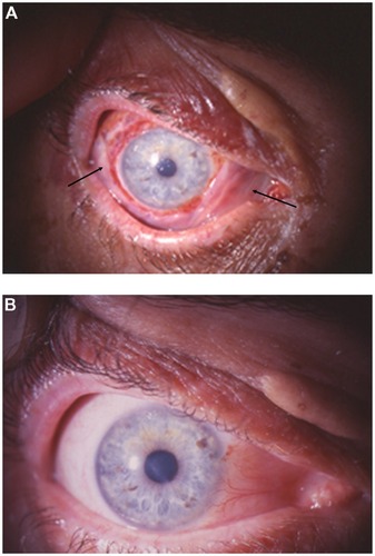 Figure 8 (A) Patient 1: 4th postoperative day with the amniotic membrane (arrows) covering the defect of the excised pathological conjunctiva and (B) 6 months after surgery; excellent ocular surface without signs of tumor recurrence.