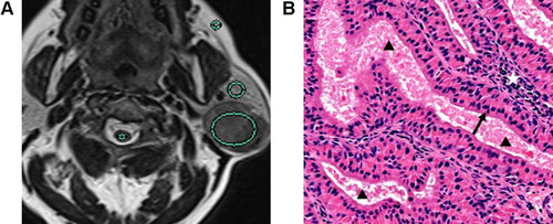 Figure 3 Warthin tumor of the left parotid gland in a 71-year-old man. (A) T2-weighted image showed that SIRP, SIRC and SIRF were 0.54 (304.32/563.56), 1.19 (304.32/255.73), and 0.35 (304.32/869.49), respectively. (B) Pathological image (original magnification × 200) revealed plenty of cysts mainly composed of eosinophilic proteinaceous secretions (black triangle). The cysts were lined with papillary proliferation of pseudostratified columnar epithelia (black arrow) and supporting stroma containing lymphoid tissue (white pentagram).