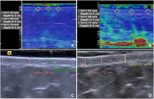 Figure 2 Shear-wave elastography, 8-MHz, (A and B) and high-frequency ultrasound, 18-MHz (C and D) at the abdomen in a healthy control (A and C) and a patient with systemic sclerosis (B and D). Mean of three shear-wave velocity values was 1.7m/s (A) and mean dermal thickness was 1.55 mm in the control (C), and 2.2 m/s (B) and 1.76 mm (D) in the patient. The shear-wave velocities’ values are displayed in a quantitative data box, at the left side of the image. Higher shear-wave velocity values indicate higher tissue stiffness. The colour scale indicate the stiffness of all tissues within the region of interest. (red=hard tissue; blue=soft tissue).
