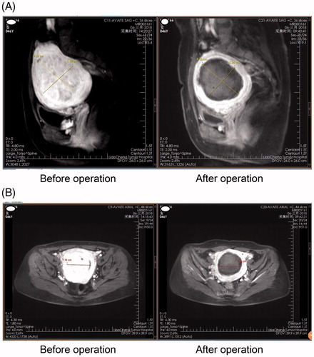 Figure 1. Contrast-enhanced MRI of uterine fibroids before and after microwave ablation. (A) Sagittal plane; (B) axial plane.