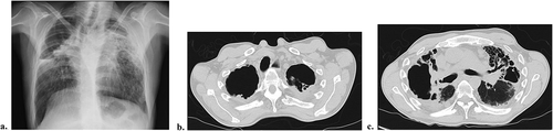 Figure 1. Chest CT and x-ray during first admission to Pulmonary Department. Chest x-ray depicting right upper lobe (RUL) cavity, retractile findings, and bilateral lung volume loss (a). Axial chest CT image evidencing important upper lobe volume loss, apical cavitary lesions and multiple cylindric bronchiectasis (b and c).