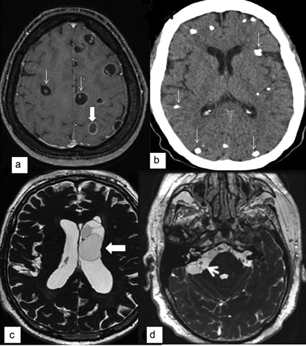 Figure 1. Imaging of parenchymal and extraparenchymal neurocysticercosis.(A) MRI post-gadolinium T1 sequence showing viable cysts with scolex (thin arrows) and a transitional or degenerative-choloidal cyst (wide arrow).(B) CT scan showing multiple parenchymal calcifications (arrows).(C) 3D MRI sequence (FIESTA) showing cysts into the left ventricle (arrow).(D) 3D MRI sequence (FIESTA) showing cysticerci at the right cerebellopontine cistern (arrow).