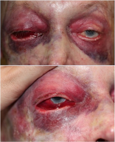 Figure 1 Facial photographs ~6 hours after surgery.