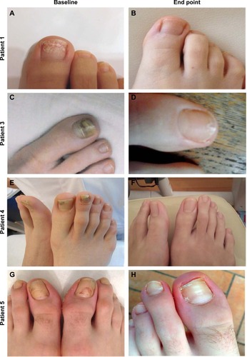 Figure 1 Representative clinical images of four patients at baseline and end point (12 weeks, topical tazarotene 0.1% gel therapy).
