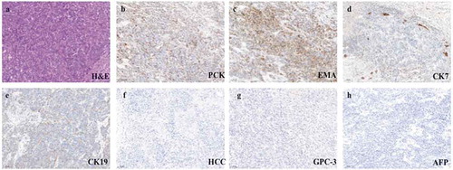 Figure 2. Representative postoperative pathological images of primary tumor (100×; a, hematoxylin and eosin stain; b–h, immunohistochemical stain).