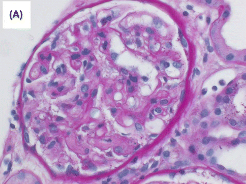 Figure 1a. Mild transplant glomerulitis was noted. Segmental glomerular fibrinoid necrosis with karyorrhexis was evident in one glomerulus (periodic acid Schiff (PAS) stain).