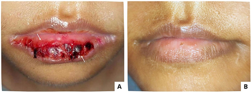 Figure 4 Clinical features of patient Case 4 (A) On the first visit, there was a hemorrhagic crust on the lower lips (B) After five days, the lesion resolved.