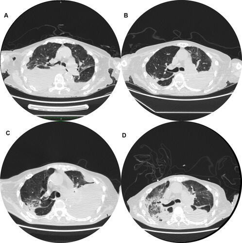 Figure 1 Changes in chest CT findings during the course of the disease. (A) Taken on 8 June 2020, Initial stage: Chest CT showed bilateral pleural effusion as well as left interlobar effusion and no manifestation of acute inflammation and space-occupying lesions. (B) Taken on 15 July 2020, Remission stage: slowly increasing tendency of the left pleural effusion and no increasing in right pleural effusion. (C) Taken on 17 August 2020, Relapse stage: obvious increase of left pleural effusion and decrease of right pleural effusion. (D) Taken on 3 September 2020, Terminal stage: Ground-glass opacity and consolidation in the right lung, diffuse ground-glass opacity in the left lung, the progression of lesions in upper lobe and decrease of bilateral pleural effusion.