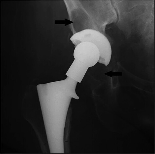 Figure 5. Bone loss surrounding a hip implant. (Reproduced from [Citation149].)