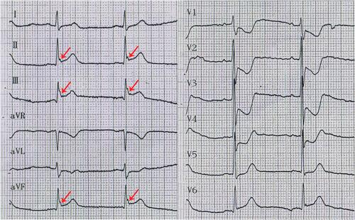 Figure 2 The ECG of a 55-year-old man presenting with chest pain for approximately 1 h. A notch J wave (indicated by red arrows) is present in leads II, III, AVF, and V6 with ST segment elevation consistent with the scope of blood supply to the RCA.