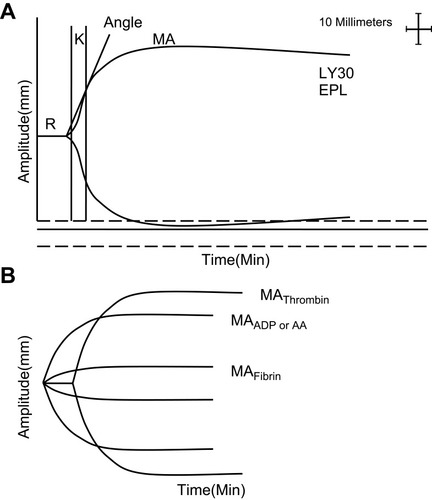 Figure 1 Explanation of TEG and TEG-PM. (A) TEG parameters: K, Angle, MA, EPL and LY30. (B), TEG-PM parameters: MAThrombin, MAADP/AA, and MAFibrin. R, reaction time to clot formation; K, clotting time until 20-mm amplitude is achieved; Angle, time to reach a maximum speed of initial clot formation.