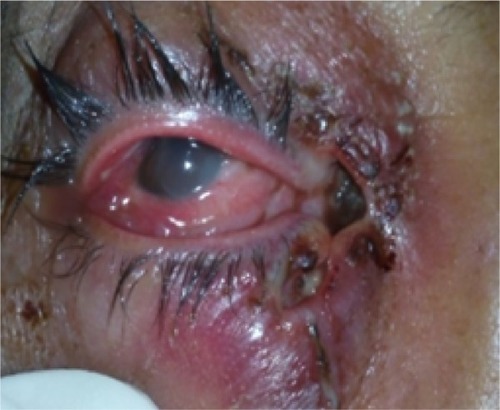 Figure 2 Lesion at the medial canthus, with free-moving maggots.