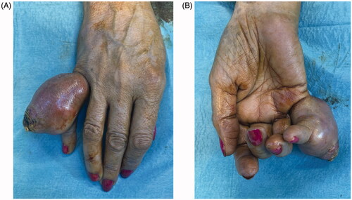 Figure 1. Preoperative photographs of the tumor, dorsal view (A), palmar view (B).