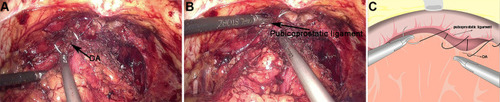Figure 4 The reconstruction of the anterior of total urethral reconstruction of the “Sandwich”. (A) The structural location of the detrusor apron (DA) during the operation. (B) The structural location of the pubicoprostatic ligament. (C) The pubicoprostatic ligament is sutured with the bladder wall behind the anterior lip of the bladder neck (equivalent to the position of DA).