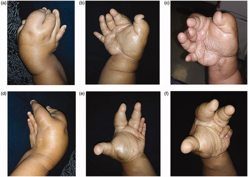 Figures 2. (a–f) Physical findings: The overgrowth of the ring and little fingers, as well as of the palm corresponding to the fourth and fifth metacarpal bones was not obvious in the left hand.