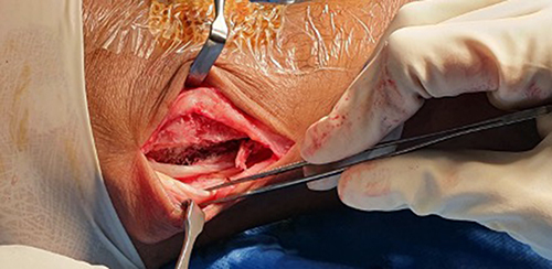 Figure 8 Split tear of peroneal brevis tear was identified during surgery, debridement of frayed tissue and tubularization were performed. Note also the groove deepening had been performed.
