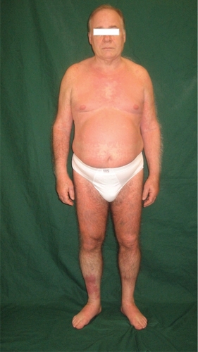 Figure 1 A suberythrodermic status involving large parts of the body. A large, red, circular edematous spot can be seen on the anterior pretibial right region.