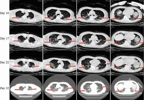 Figure 7. Chest CT scans on days 10, 17, 22, and 32 after onset for Pt-5. CT showed scattered bilateral multiple high-density effusions, faintly exudative shadows along the lungs on day 10. Effusions were gradually absorbed and partially fibrotic over time. Red arrows indicate typical lesions.