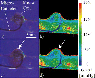 Figure 11 (a) Micro-coil while being deployed into the saccular aneurysm model. (b) Corresponding stress analysis. (c) Release mechanism deployed into the aneurysm model produces birefringence in the blood vessel model wall (arrow). (d) Corresponding stress analysis (color figure available online).